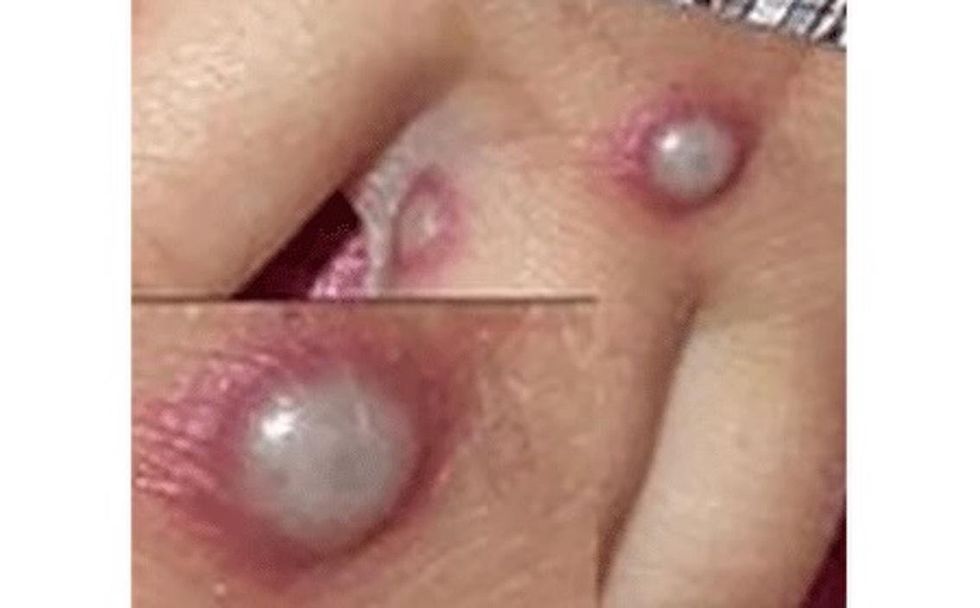 monkeypox rash on 
