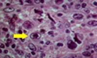 reed-sternberg cell