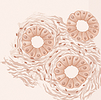 Illustration showing abnormal cells that still appear as rings in grade 1 or 2 of prostate cancer