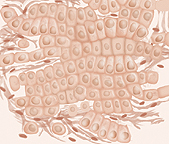 Illustration showing abnormal cells that vary even more in size and shape in grade 4 or 5 of prostate cancer